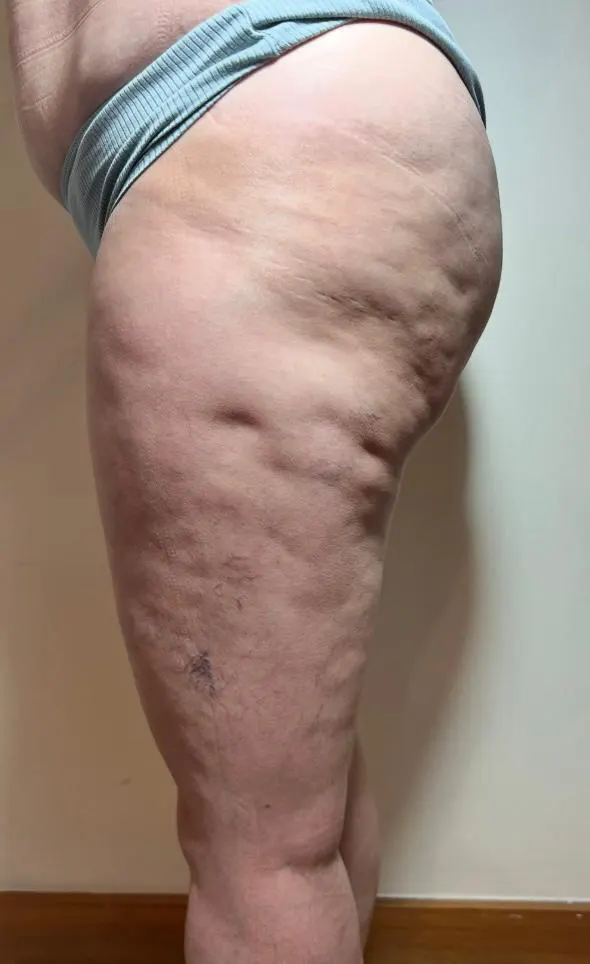 celulitis-antes