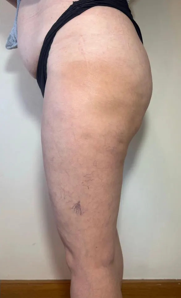 celulitis-despues